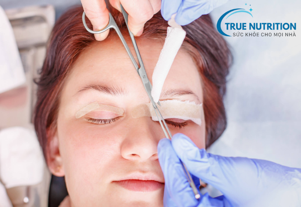 Cắt mí: Những điều bạn cần biết trước khi thực hiện