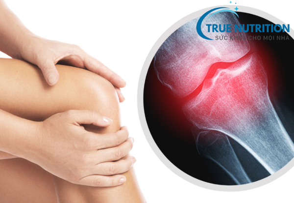 Tại sao xương khớp kêu? Có nguy hiểm không?