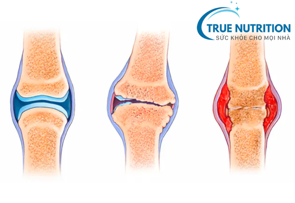 Đau nhức viêm khớp: Điều trị và phòng ngừa đúng cách