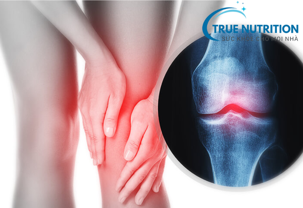 Đau nhức viêm khớp: Điều trị và phòng ngừa đúng cách