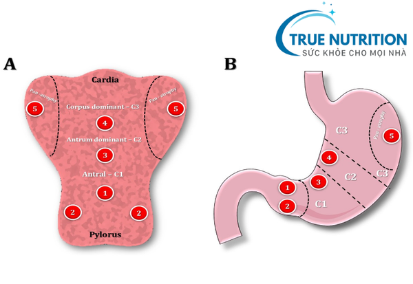 viêm teo niêm mạc dạ dày kimura c3