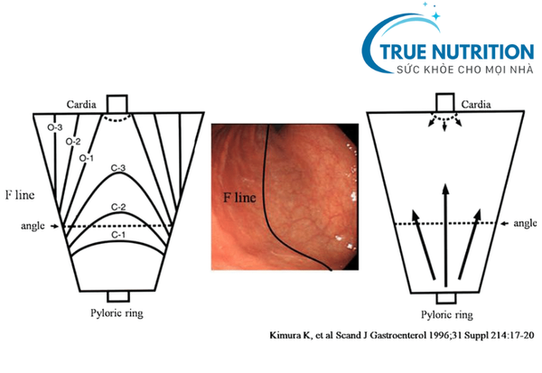 viêm teo niêm mạc dạ dày kimura c2