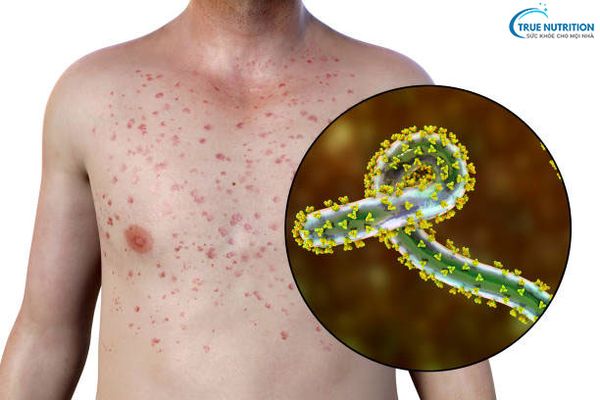 Mẹo Dân Gian Chữa Sốt Phát Ban: Hiệu Quả, An Toàn Và Dễ Áp Dụng