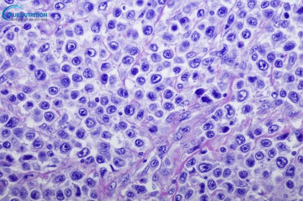 U Lympho Không Hodgkin Tế Bào B Lớn Tỏa Rộng Tìm Hiểu Về Căn Bệnh, Nguyên Nhân, Triệu Chứng Và Phương Pháp Điều Trị