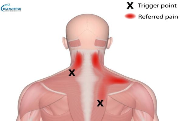Trigger Point Là Gì? Nguyên Nhân & Liệu Pháp Điều Trị