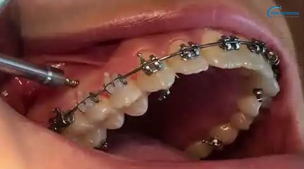 Minivis Chỉnh Nha, Giá, Tác Dụng, Lưu Ý, Thời Gian