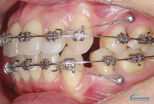 Minivis Chỉnh Nha, Giá, Tác Dụng, Lưu Ý, Thời Gian