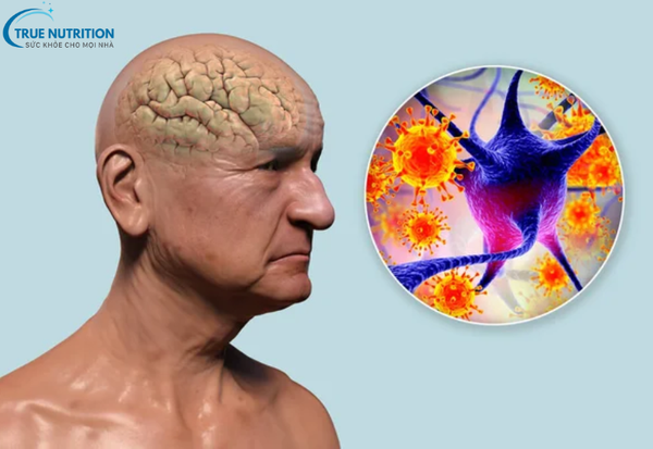 Bệnh Alzheimer Là Gì? Giải Pháp Phòng Ngừa và Chăm Sóc Toàn Diện