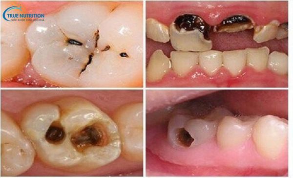 Triệu Chứng Sau Khi Lấy Tủy Răng: Phân Biệt Bình Thường Và Bất Thường