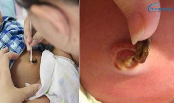 Hình ảnh rốn trẻ sơ sinh bị nhiễm trùng: Nhận biết, điều trị và phòng ngừa