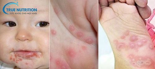 Cách Nhận Diện Hình Ảnh Trẻ Bị Chân Tay Miệng: Dấu Hiệu và Điều Trị