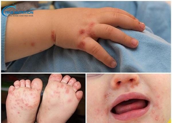 Cách Nhận Diện Hình Ảnh Trẻ Bị Chân Tay Miệng: Dấu Hiệu và Điều Trị