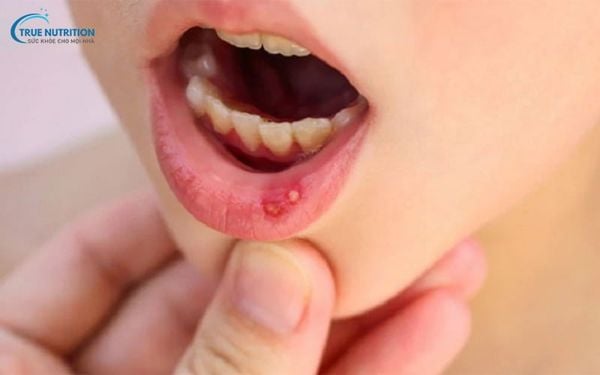 Hình Ảnh Mụn Thịt Trong Miệng: Nguyên Nhân, Điều Trị và Phòng Ngừa