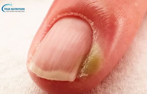 Cách Chữa Chín Mé Bằng Kem Đánh Răng Khoa Học Nói Gì?