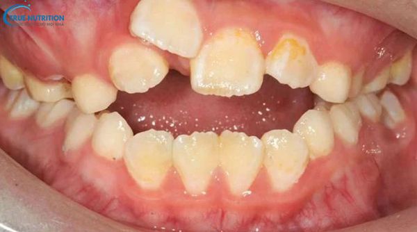 Nhận Diện Hình Ảnh Răng Mọc Lẫy: Xử Lý, Giá Nhổ Răng