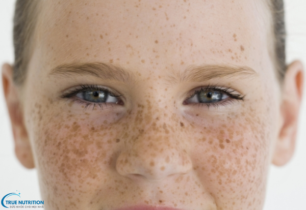 Các Loại Bệnh Nám Da: Các Dạng Nám Phổ Biến và Cách Phòng Ngừa