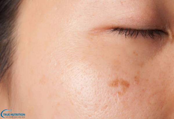 Các Loại Bệnh Nám Da: Các Dạng Nám Phổ Biến và Cách Phòng Ngừa