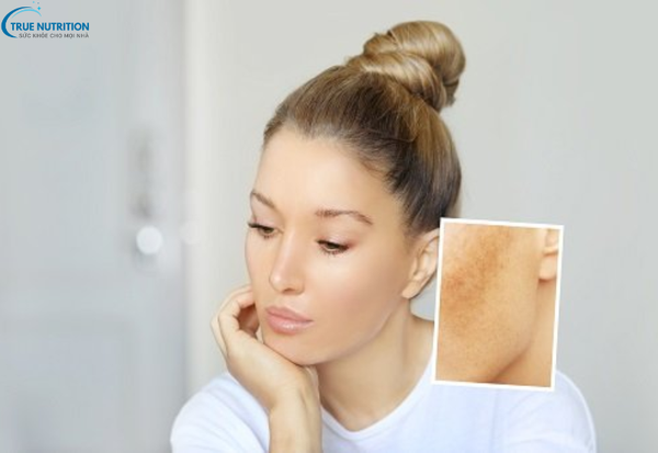 Các Loại Bệnh Nám Da: Các Dạng Nám Phổ Biến và Cách Phòng Ngừa