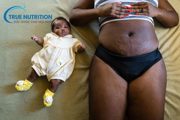 5 Giải pháp cải thiện rạn da sau sinh hiệu quả