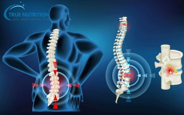 Bài Tập Thoái Hóa Đốt Sống Lưng