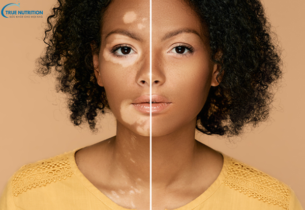 Dấu Hiệu Bệnh Bạch Biến: Nhận Biết Sớm Để Bảo Vệ Làn Da Của Bạn