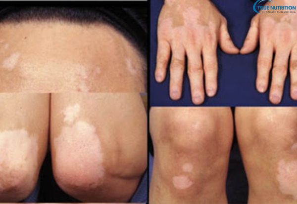 Dấu Hiệu Bệnh Bạch Biến: Nhận Biết Sớm Để Bảo Vệ Làn Da Của Bạn