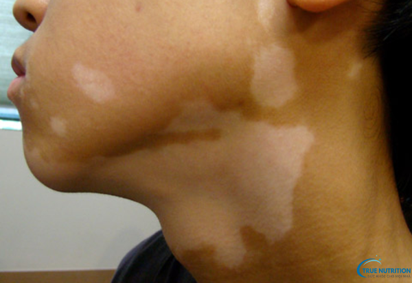 Dấu Hiệu Bệnh Bạch Biến: Nhận Biết Sớm Để Bảo Vệ Làn Da Của Bạn