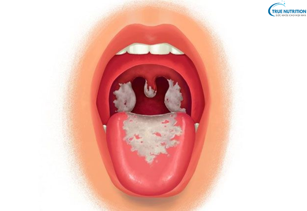 Nhận Biết Các Triệu Chứng Của Bệnh Bạch Hầu: Những Biểu Hiện Cần Lưu Ý