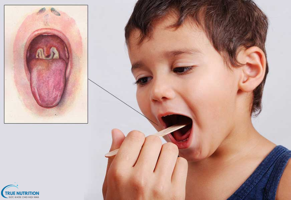 Nhận Biết Các Triệu Chứng Của Bệnh Bạch Hầu: Những Biểu Hiện Cần Lưu Ý