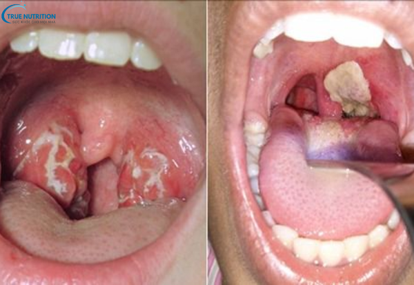 Nhận Biết Các Triệu Chứng Của Bệnh Bạch Hầu: Những Biểu Hiện Cần Lưu Ý