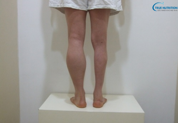 Triệu Chứng Bệnh Bại Liệt: Tìm Hiểu Những Biểu Hiện Cảnh Giác Đầu Tiên