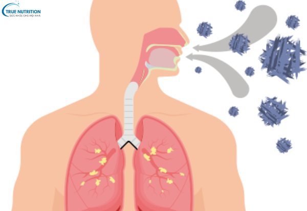 Triệu chứng bệnh bụi phổi: Những dấu hiệu cảnh báo không thể bỏ qua