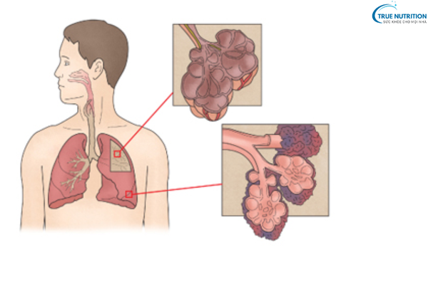 Điều Trị Bệnh Khí Phế Thũng: Giải Pháp Toàn Diện Cho Phổi Khỏe Mạnh