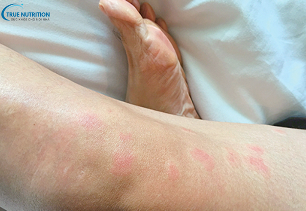 Bệnh Lupus Ban Đỏ Hệ Thống Là Gì? Triệu Chứng Và Cách Phòng Ngừa Hiệu Quả