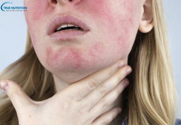 Bệnh Lupus Ban Đỏ Hệ Thống Là Gì? Triệu Chứng Và Cách Phòng Ngừa Hiệu Quả