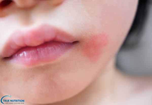 Bệnh Lupus Ban Đỏ Hệ Thống Là Gì? Triệu Chứng Và Cách Phòng Ngừa Hiệu Quả