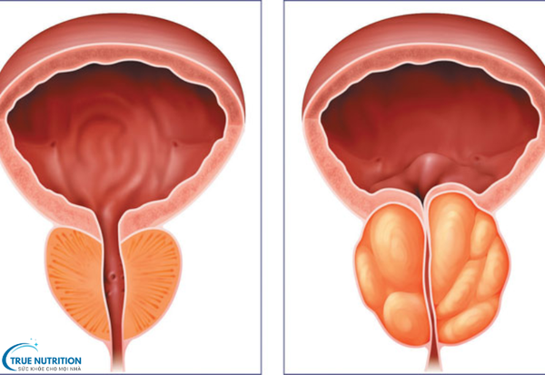 Bệnh Phì Đại Tuyến Tiền Liệt: Nguyên Nhân và Cách Phòng Ngừa Hiệu Quả