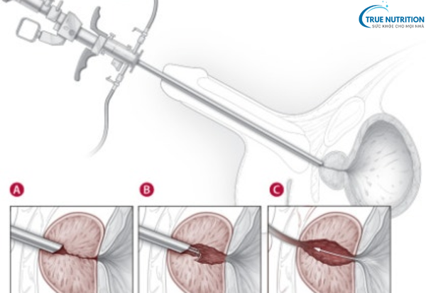 Bệnh Phì Đại Tuyến Tiền Liệt: Nguyên Nhân và Cách Phòng Ngừa Hiệu Quả