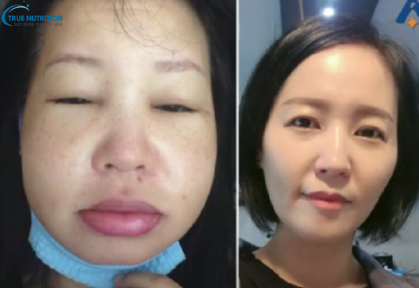 Bệnh Phù Mạch Là Gì? Những Điều Bạn Cần Biết Để Xử Lý Kịp Thời