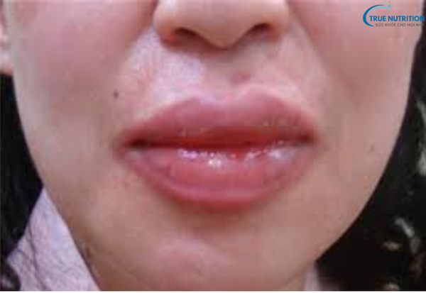 Bệnh Phù Mạch Là Gì? Những Điều Bạn Cần Biết Để Xử Lý Kịp Thời