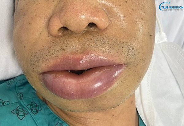 Bệnh Phù Mạch Là Gì? Những Điều Bạn Cần Biết Để Xử Lý Kịp Thời