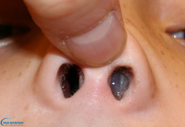 Cách chữa bệnh polyp mũi: Phương pháp điều trị và phòng ngừa tái phát