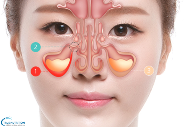 Cách chữa bệnh polyp mũi: Phương pháp điều trị và phòng ngừa tái phát