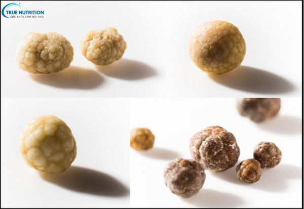 Triệu Chứng Bệnh Sỏi Mật: Các Biểu Hiện Cảnh Báo Bạn Cần Lưu Ý Ngay