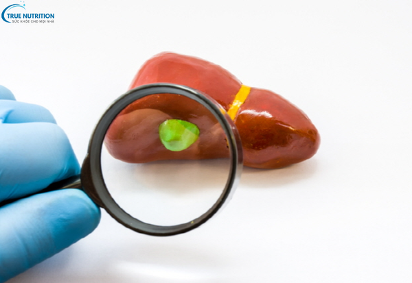 Triệu Chứng Bệnh Sỏi Mật: Các Biểu Hiện Cảnh Báo Bạn Cần Lưu Ý Ngay