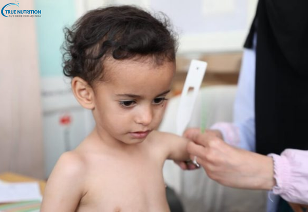 Nguyên Nhân Bệnh Suy Dinh Dưỡng: Điều Gì Khiến Cơ Thể Thiếu Hụt Dinh Dưỡng?