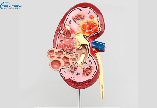 Nguyên Nhân Bệnh Thận Đa Nang: Những Yếu Tố Gây Hại Bạn Cần Biết