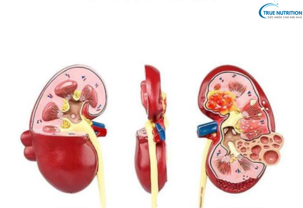 Nguyên Nhân Bệnh Thận Đa Nang: Những Yếu Tố Gây Hại Bạn Cần Biết