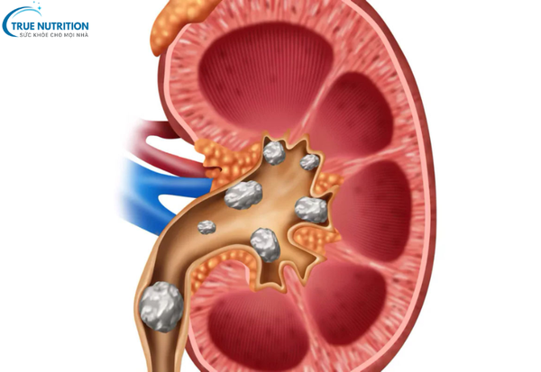 Nguyên Nhân Bệnh Thận Đa Nang: Những Yếu Tố Gây Hại Bạn Cần Biết