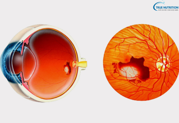 Dấu Hiệu Bệnh Thoái Hóa Điểm Vàng: Nhận Biết Sớm Để Bảo Vệ Thị Lực